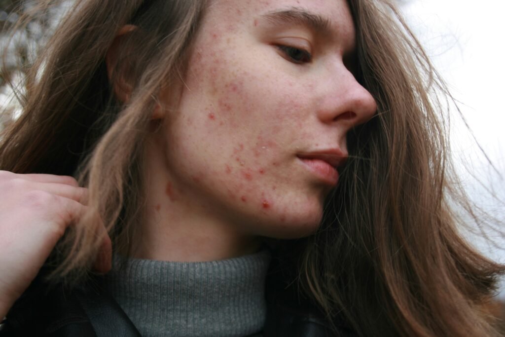 How Long Does It Take for Pimples to Go Away? Proven Tips & What Affects Healing covering pimple recovery, acne triggers, skincare routines, and treatment methods.