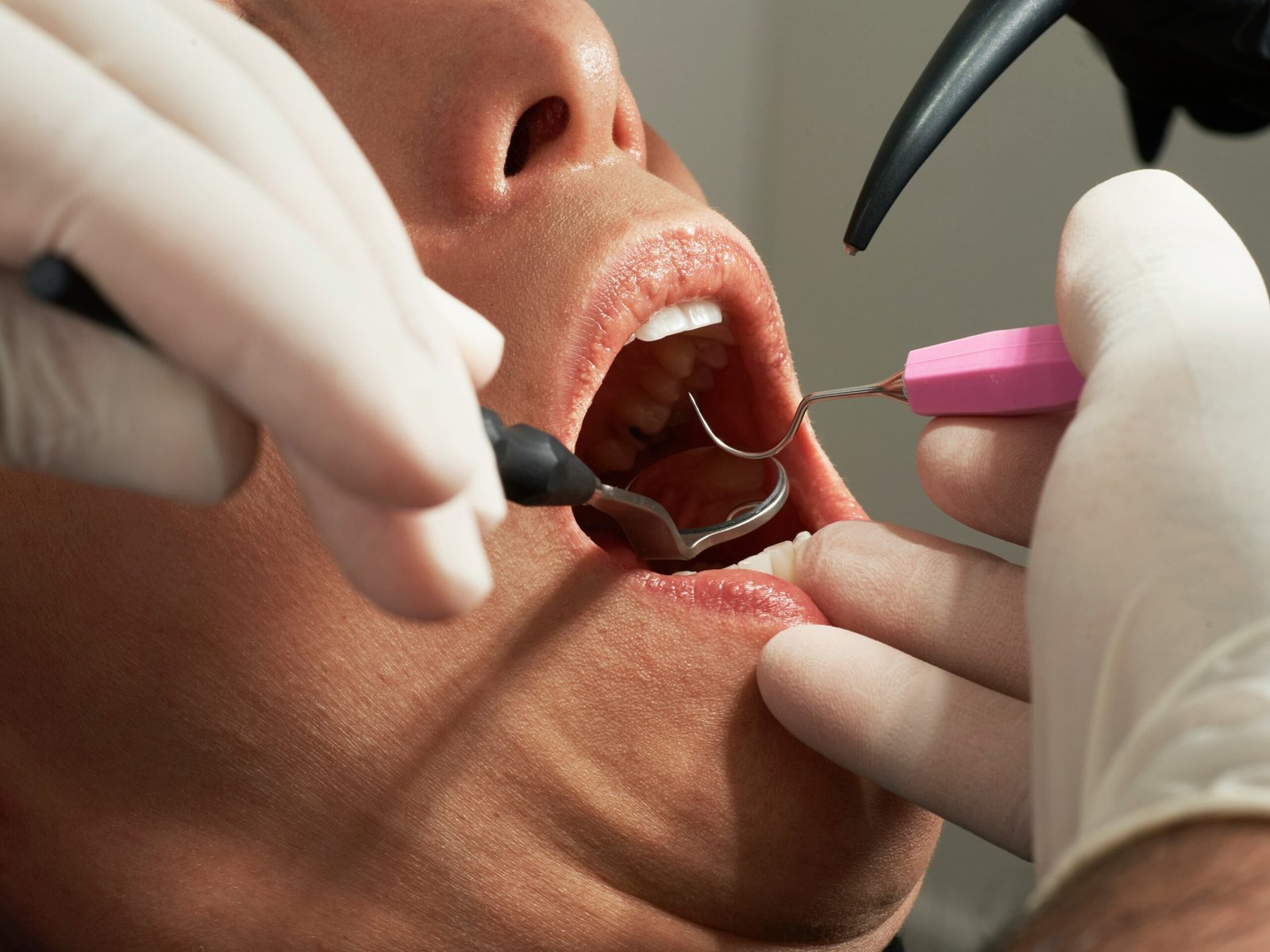 How to Squeeze Out Salivary Gland Stone Safe Removal Options